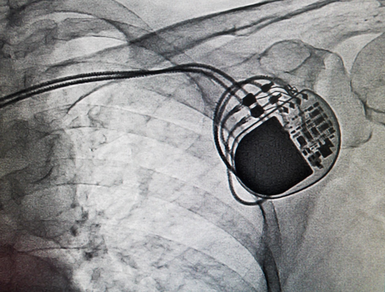 Pacemakers may be vulnerable to cyberattacks, study finds